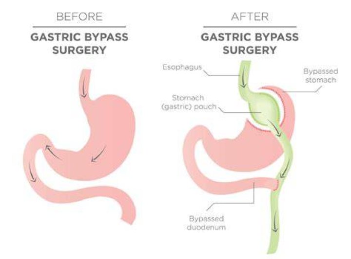 Why does a gastric bypass result in weight loss?